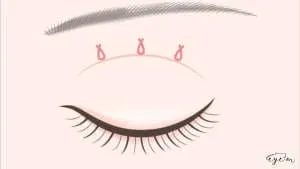 double-eyelid-burial-method